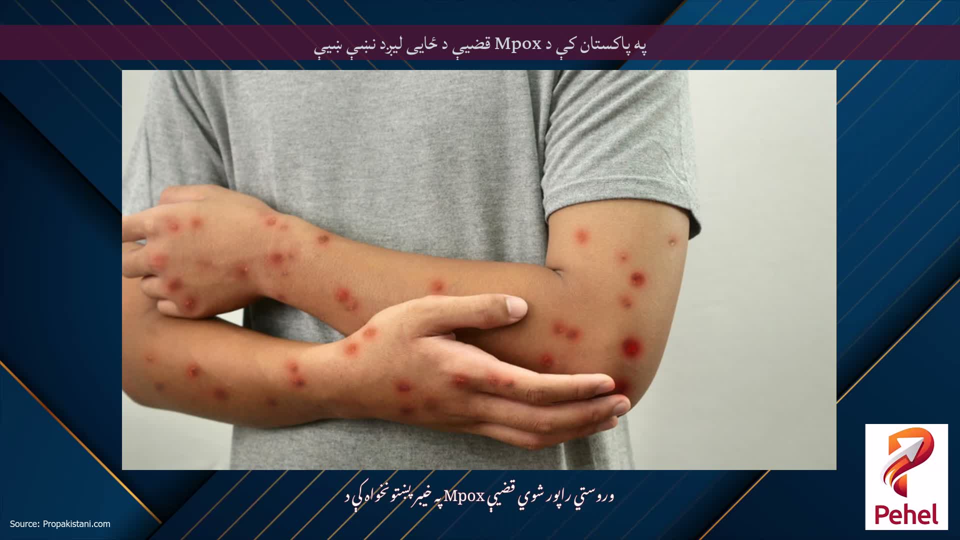 په پاکستان کې د Mpox قضیې د ځایی لیږد نښې ښیې