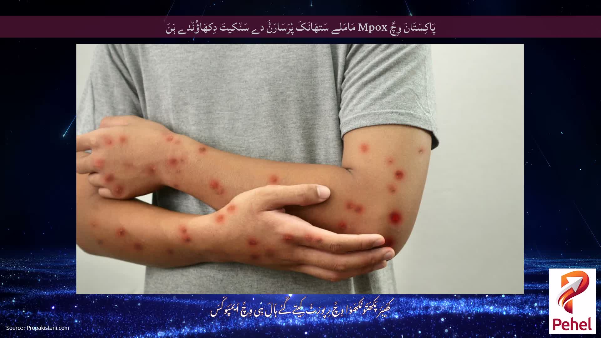 پَاکِسَتَانَ وِچَّ Mpox مَامَلے سَتھَانَکَ پْرَسَارَݨَ دے سَن٘کیتَ دِکھَاؤُن٘دے ہَنَ