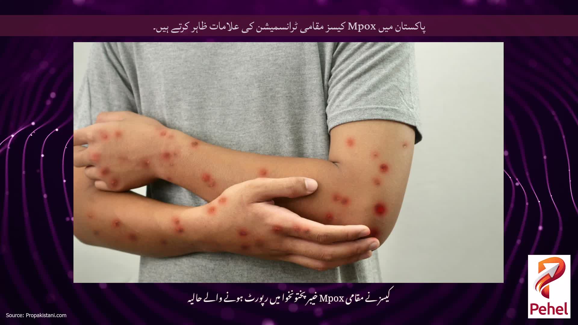 پاکستان میں Mpox کیسز مقامی ٹرانسمیشن کی علامات ظاہر کرتے ہیں۔