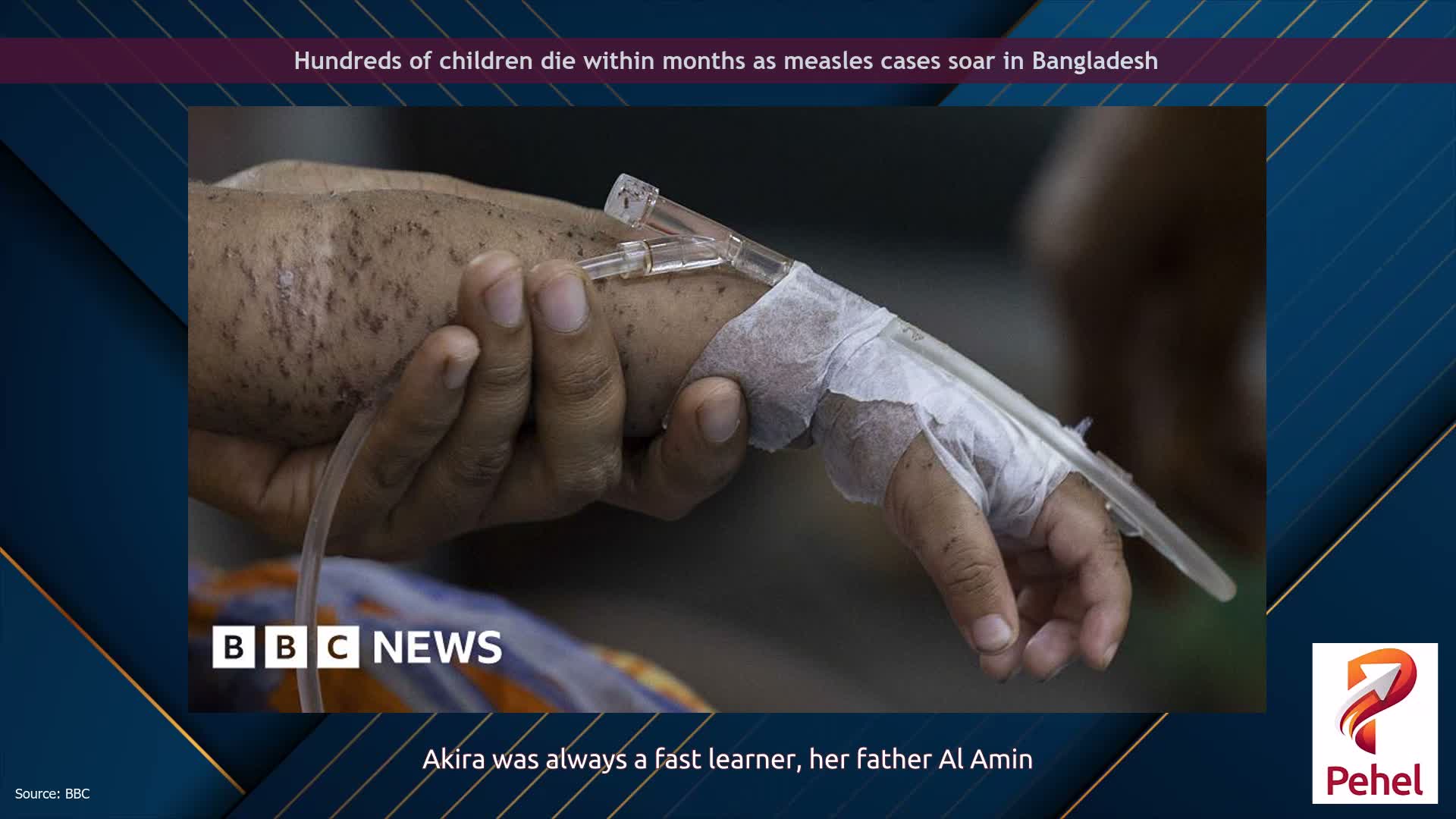 Hundreds of children die within months as measles cases soar in Bangladesh