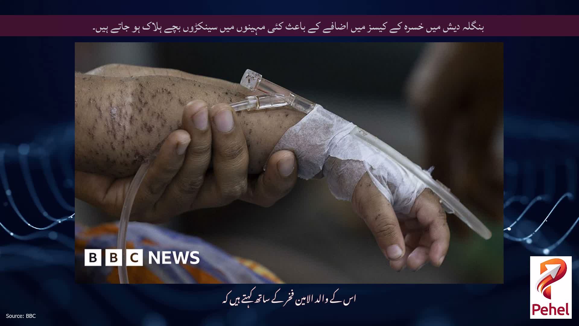 بنگلہ دیش میں خسرہ کے کیسز میں اضافے کے باعث کئی مہینوں میں سینکڑوں بچے ہلاک ہو جاتے ہیں۔