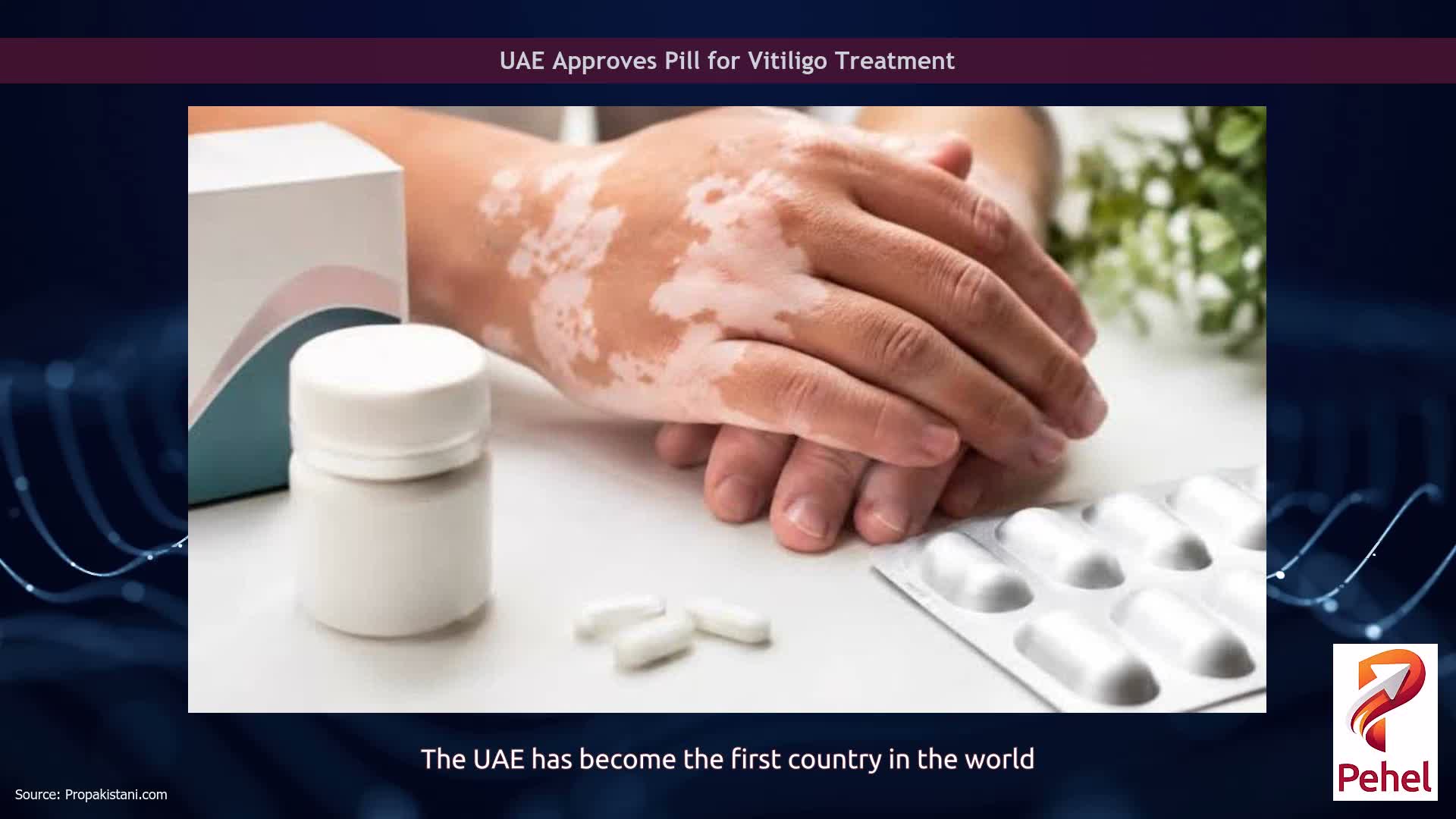 UAE Approves Pill for Vitiligo Treatment