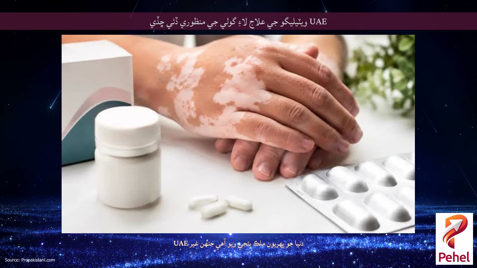UAE ويٽيليگو جي علاج لاءِ گولي جي منظوري ڏئي ڇڏي
