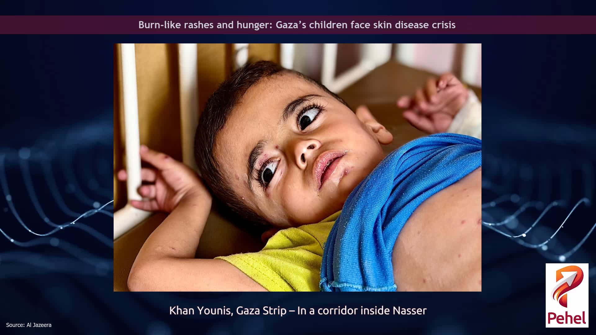 Burn-like rashes and hunger: Gaza’s children face skin disease crisis