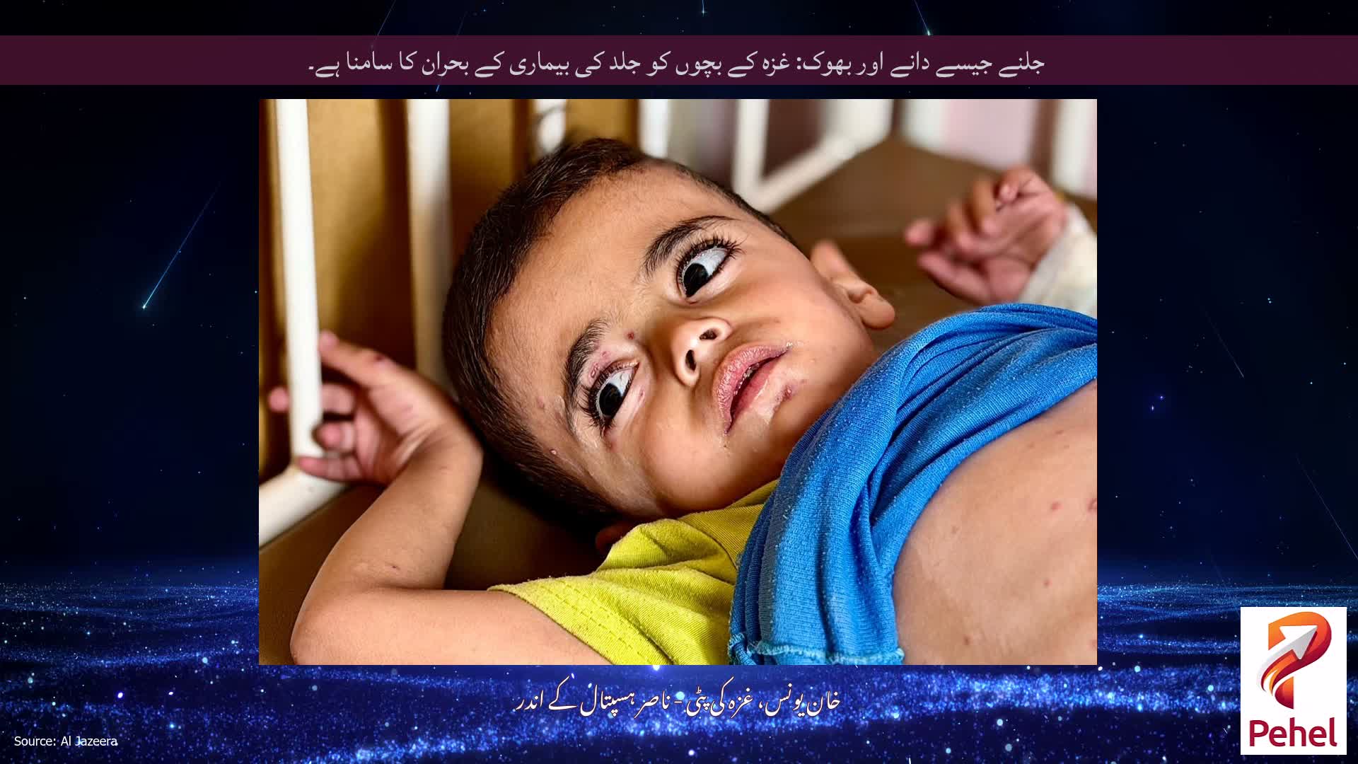 جلنے جیسے دانے اور بھوک: غزہ کے بچوں کو جلد کی بیماری کے بحران کا سامنا ہے۔
