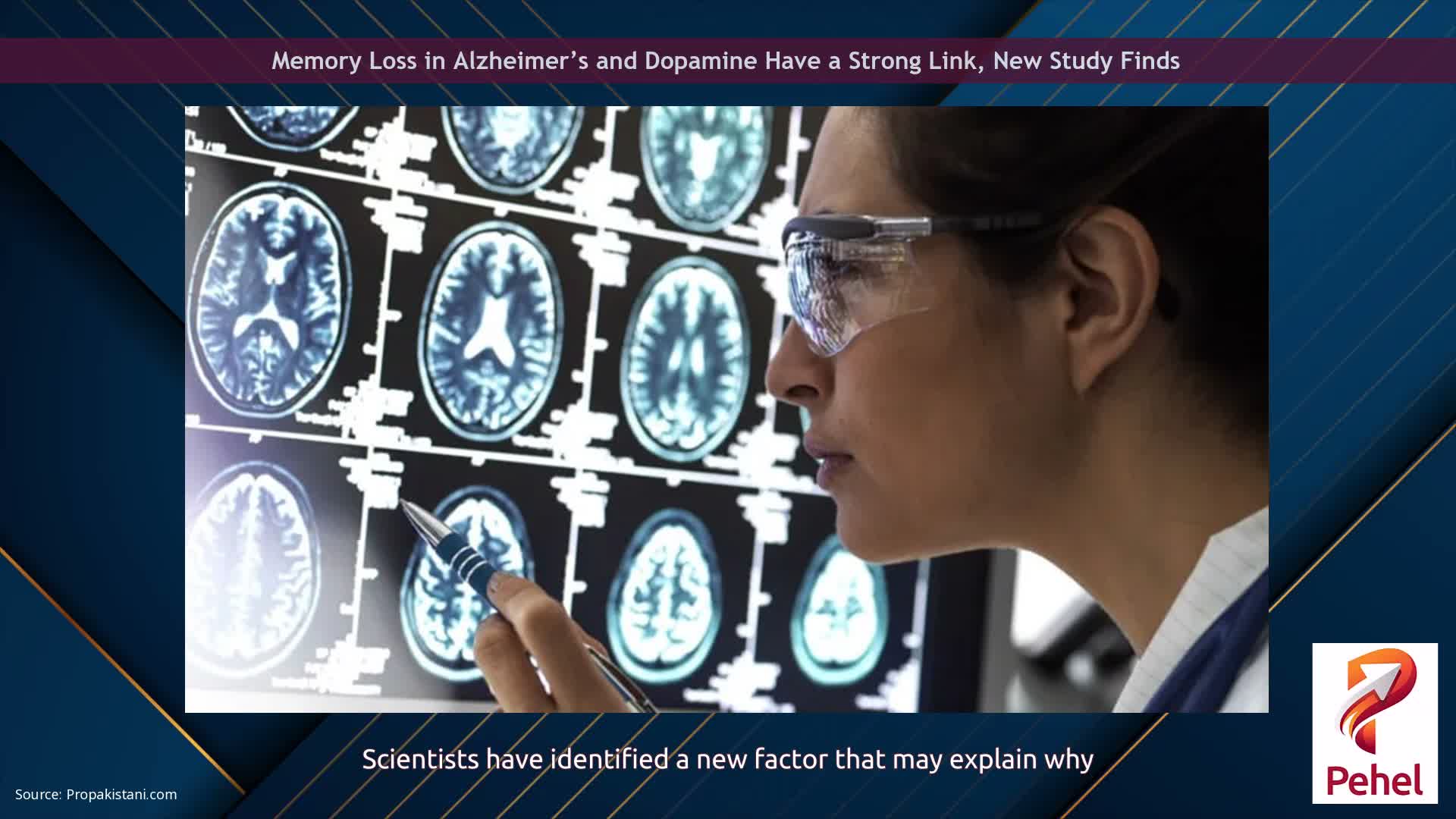 Memory Loss in Alzheimer’s and Dopamine Have a Strong Link, New Study Finds
