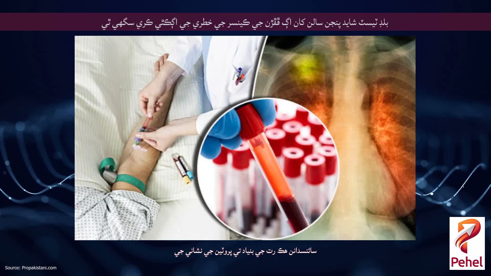 بلڊ ٽيسٽ شايد پنجن سالن کان اڳ ڦڦڙن جي ڪينسر جي خطري جي اڳڪٿي ڪري سگهي ٿي