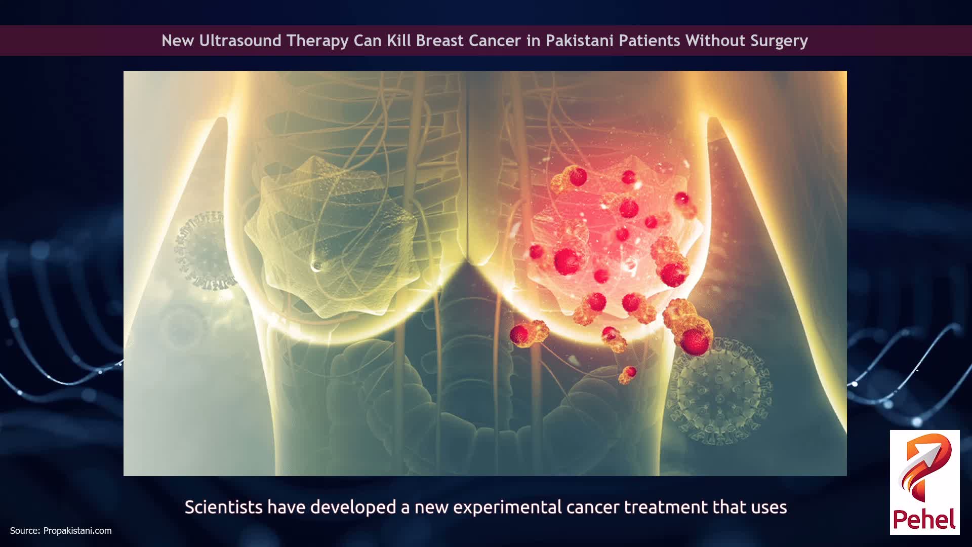 New Ultrasound Therapy Can Kill Breast Cancer in Pakistani Patients Without Surgery