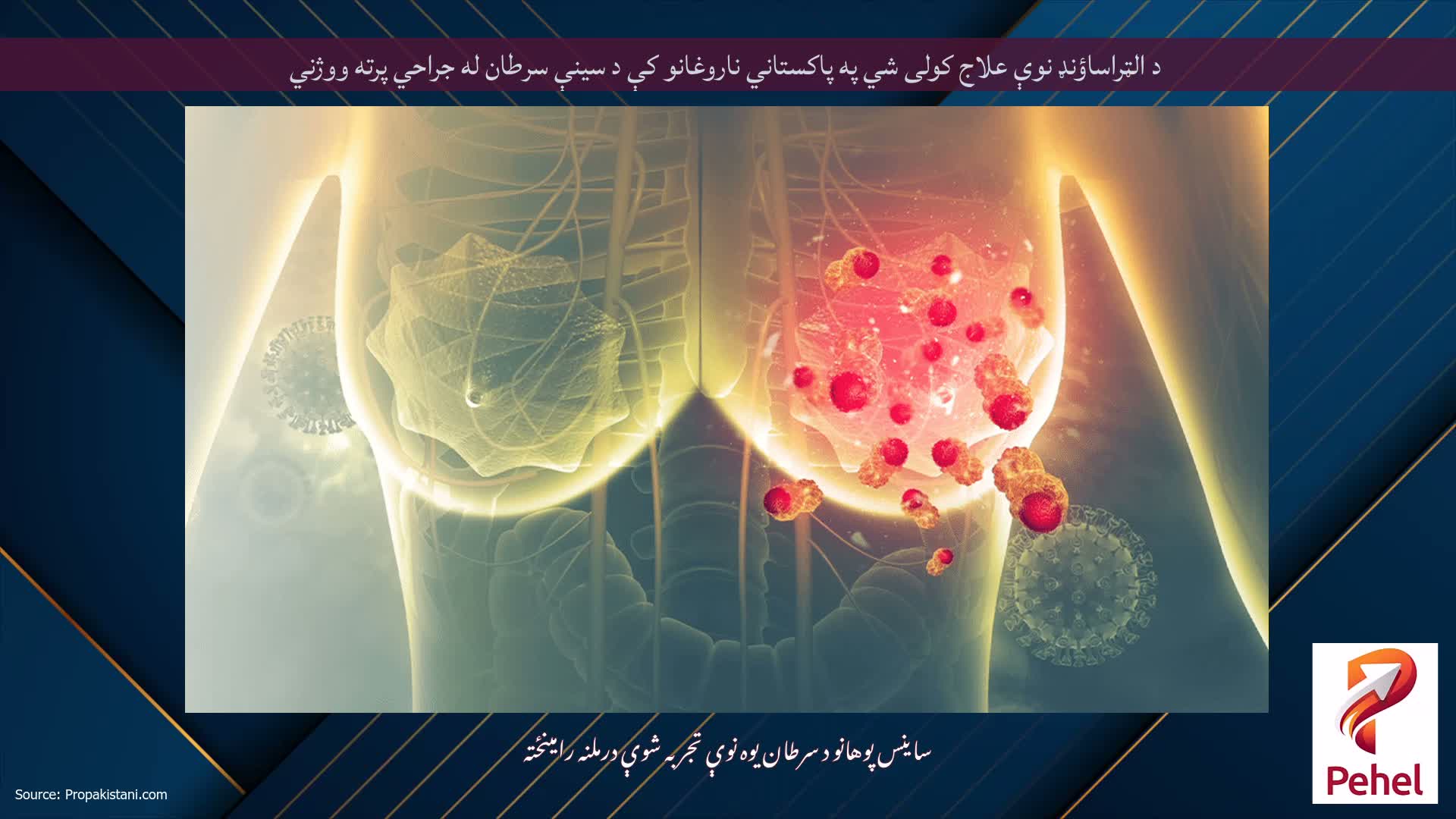 د الټراساؤنډ نوې علاج کولی شي په پاکستاني ناروغانو کې د سینې سرطان له جراحي پرته ووژني