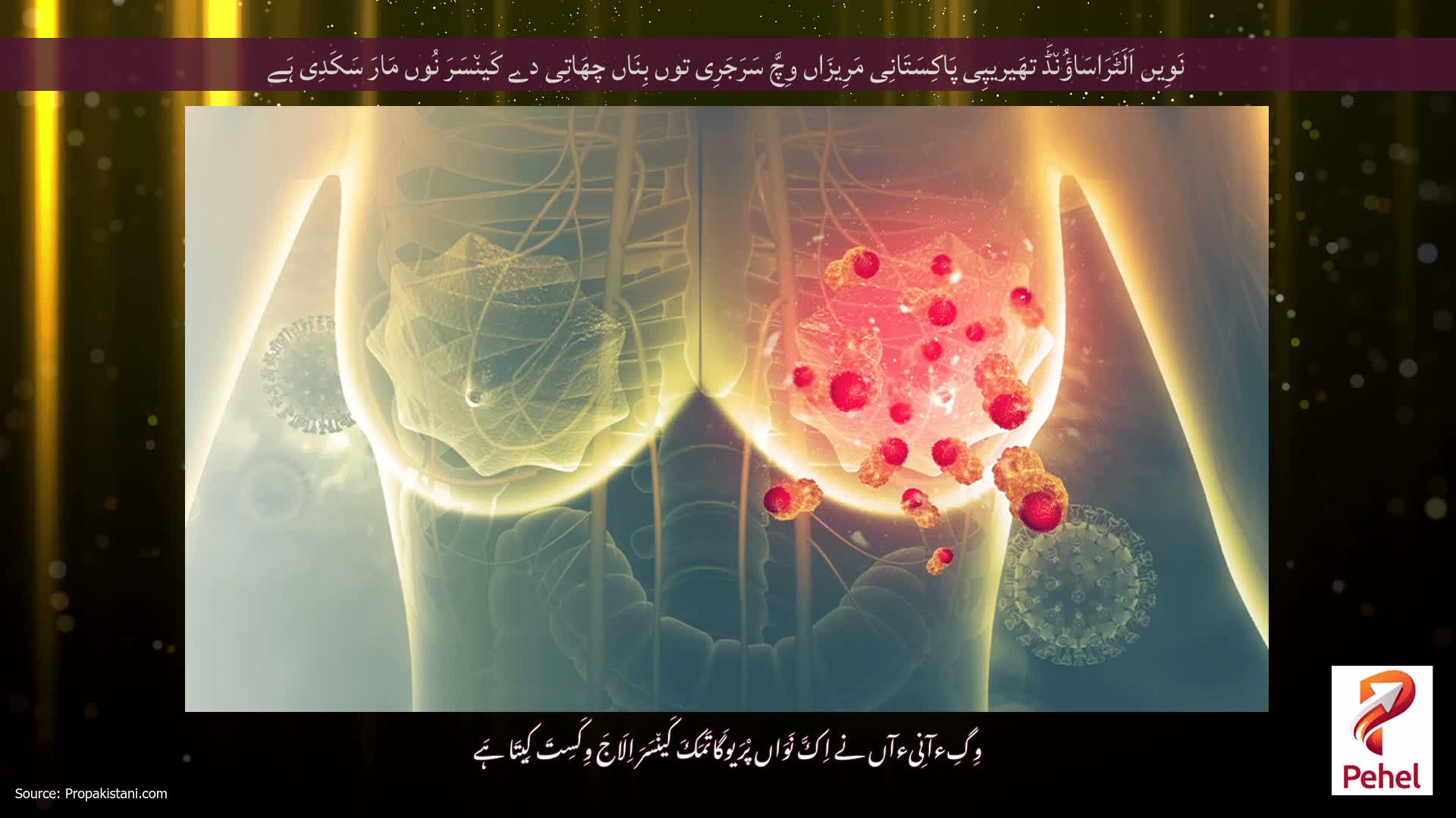 نَوِیں اَلَٹَرَاسَاؤُن٘ڈَ تھَیریپِی پَاکِسَتَانِی مَرِیزَاں وِچَّ سَرَجَرِی توں بِنَاں چھَاتِی دے کَین٘سَرَ نُوں مَارَ سَکَدِی ہَے