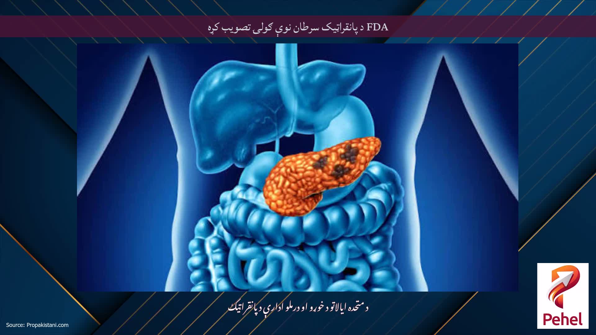 FDA د پانقراټيک سرطان نوې ګولۍ تصویب کړه
