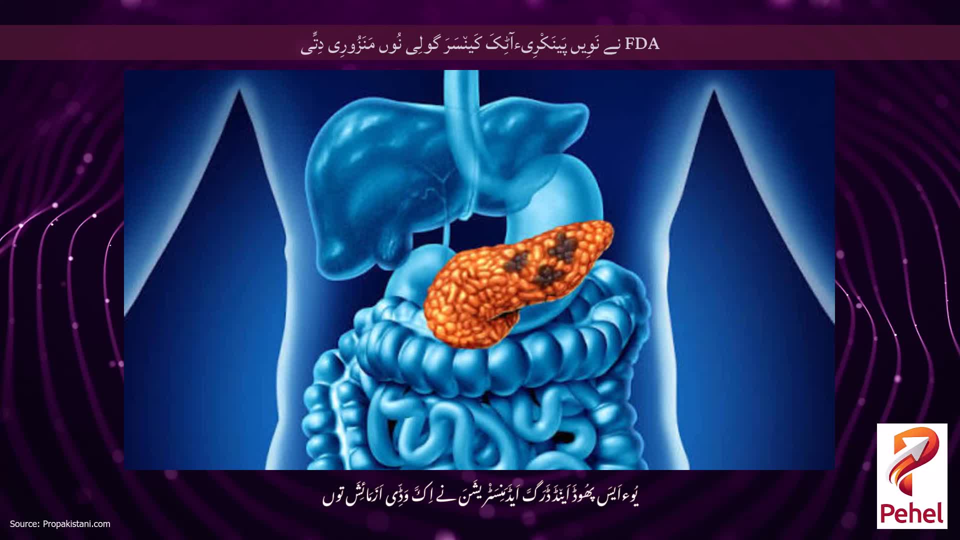 FDA نے نَوِیں پَینَکْرِیءآٹِکَ کَین٘سَرَ گولِی نُوں مَنَزُورِی دِتِّی