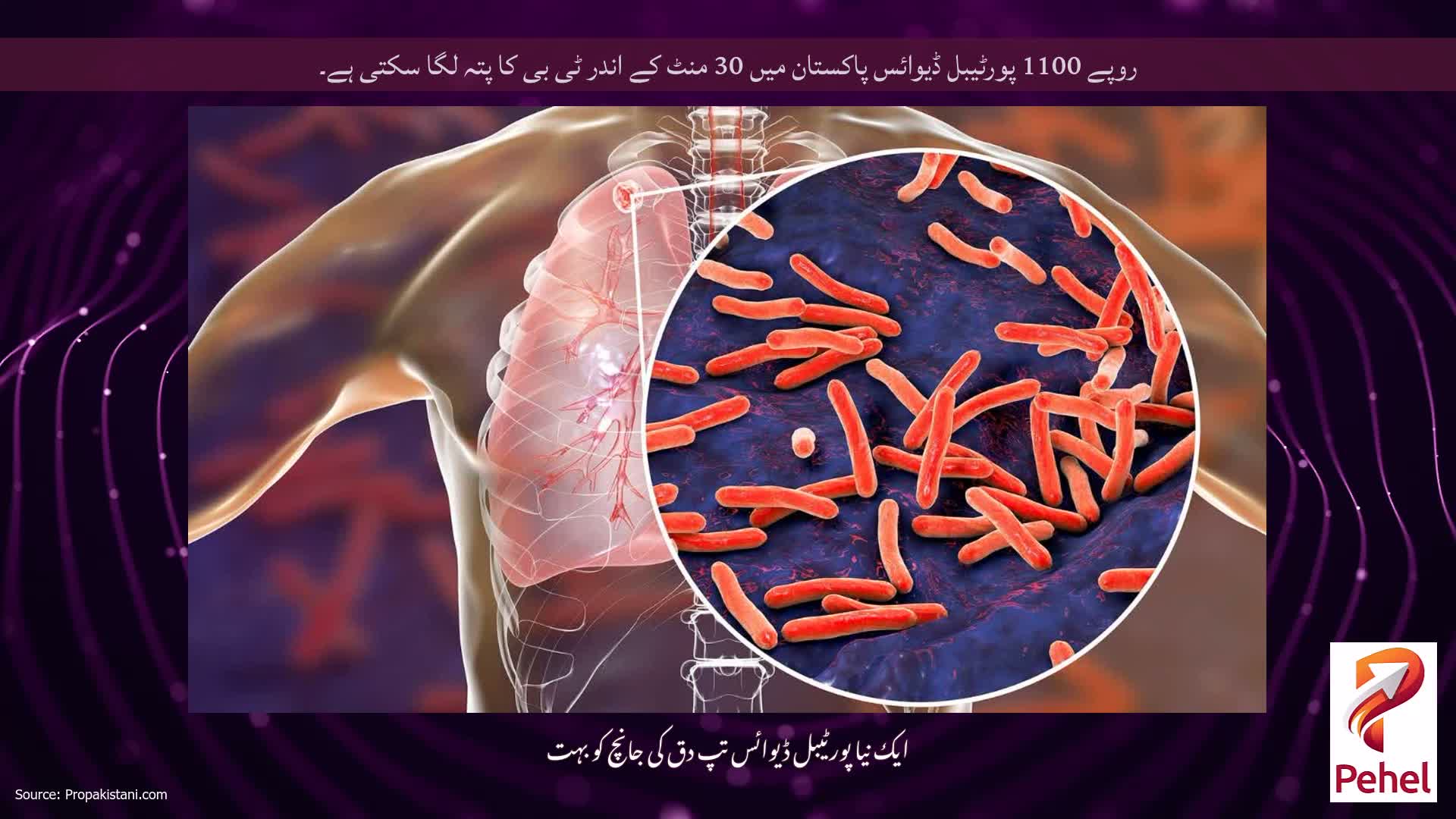 روپے 1100 پورٹیبل ڈیوائس پاکستان میں 30 منٹ کے اندر ٹی بی کا پتہ لگا سکتی ہے۔