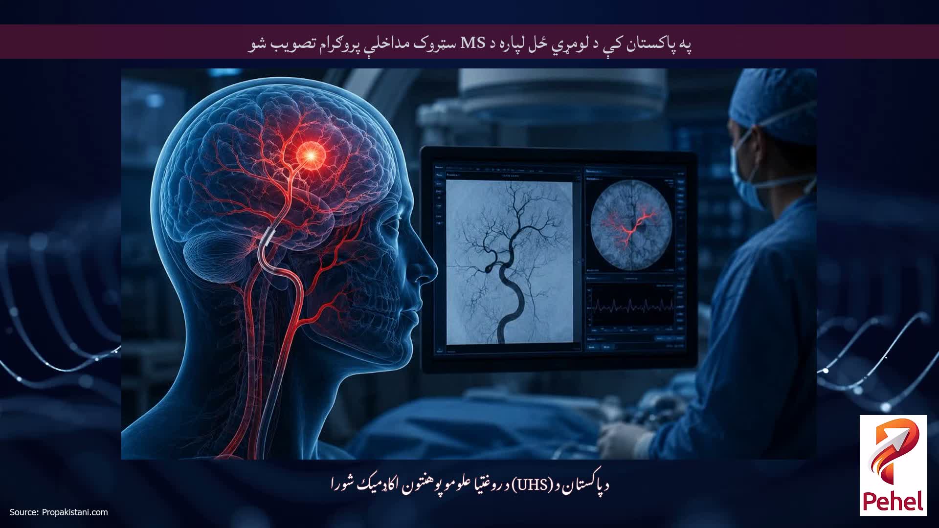 په پاکستان کې د لومړي ځل لپاره د MS سټروک مداخلې پروګرام تصویب شو