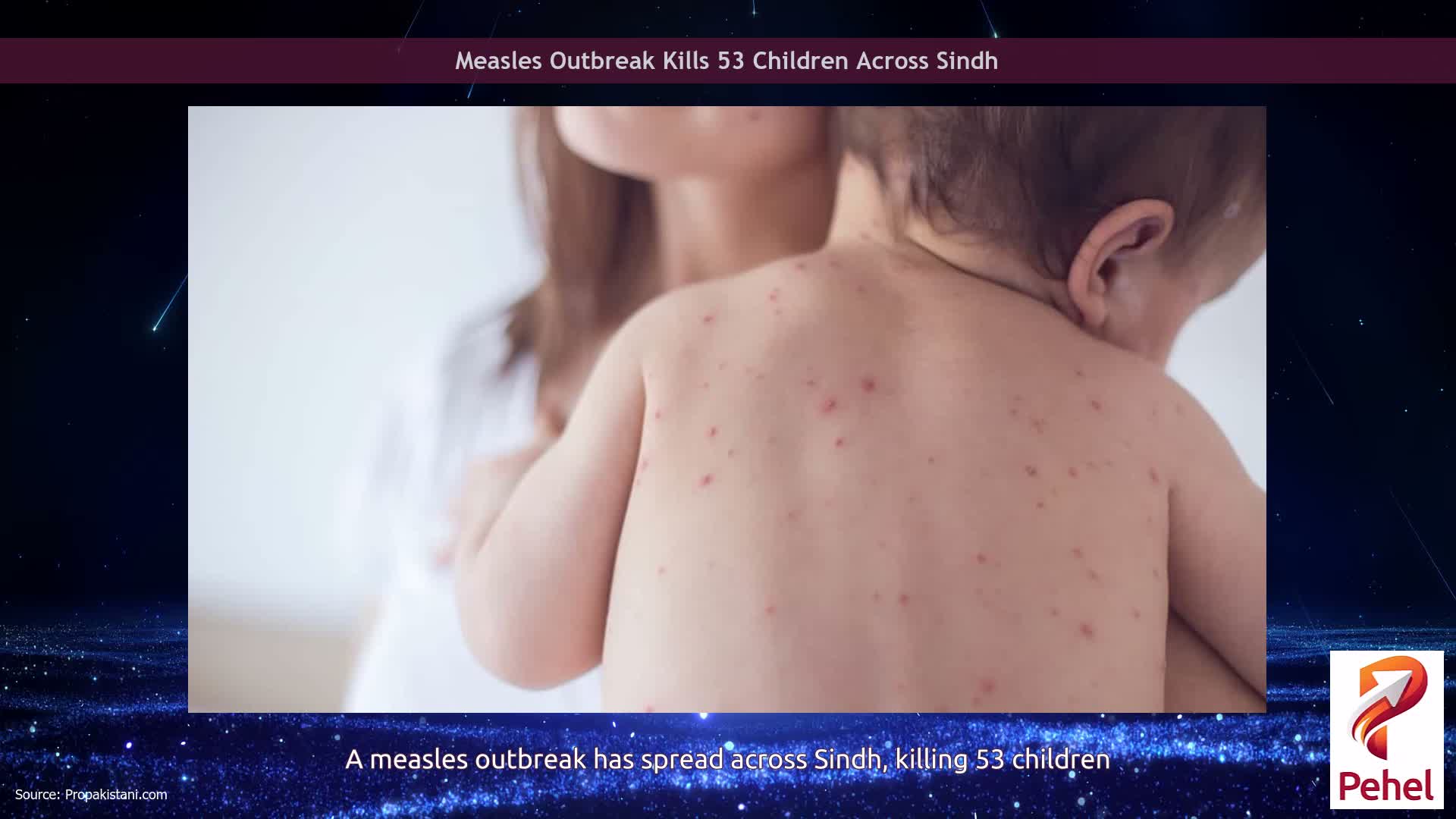 Measles Outbreak Kills 53 Children Across Sindh