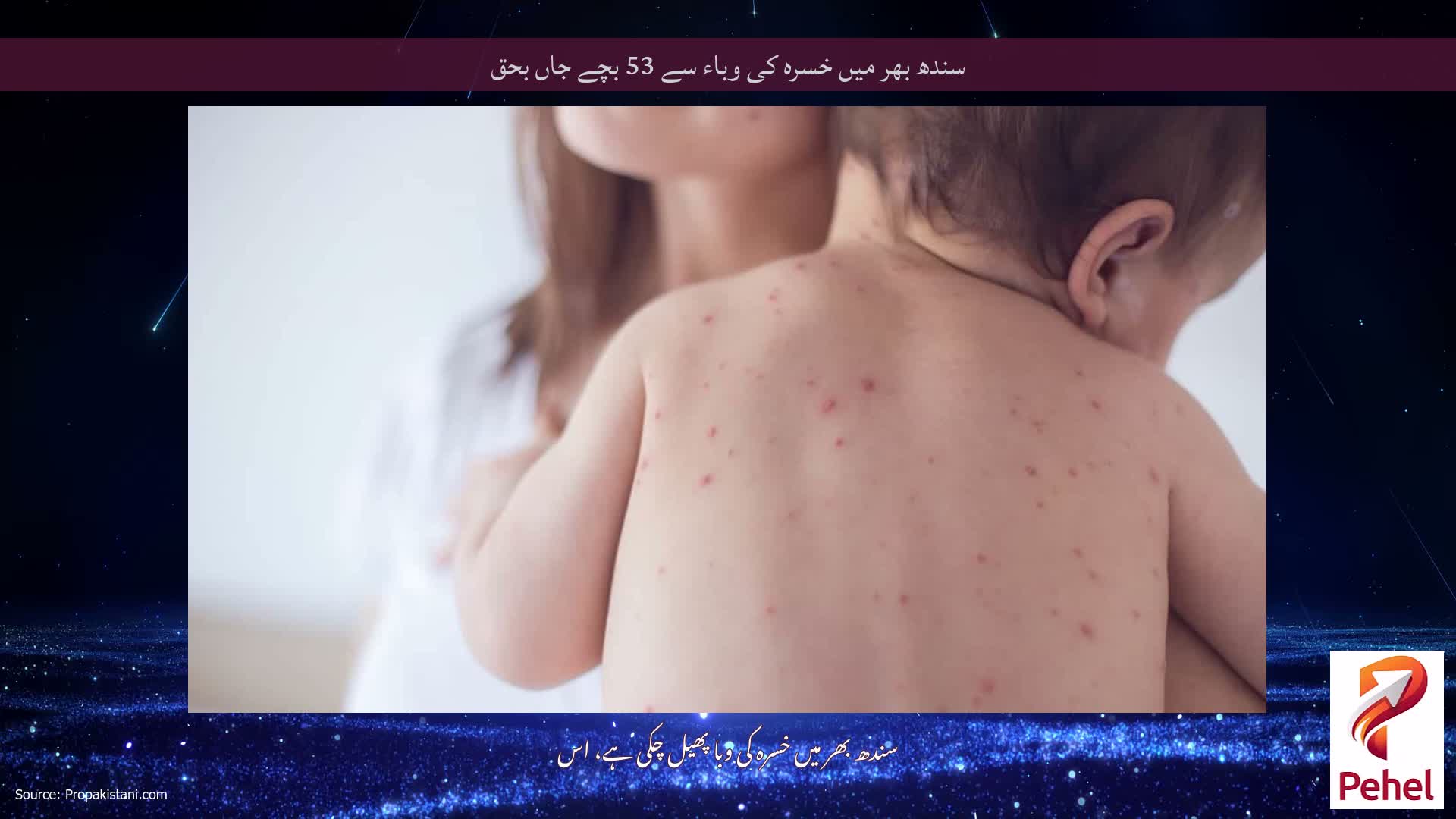 سندھ بھر میں خسرہ کی وباء سے 53 بچے جاں بحق