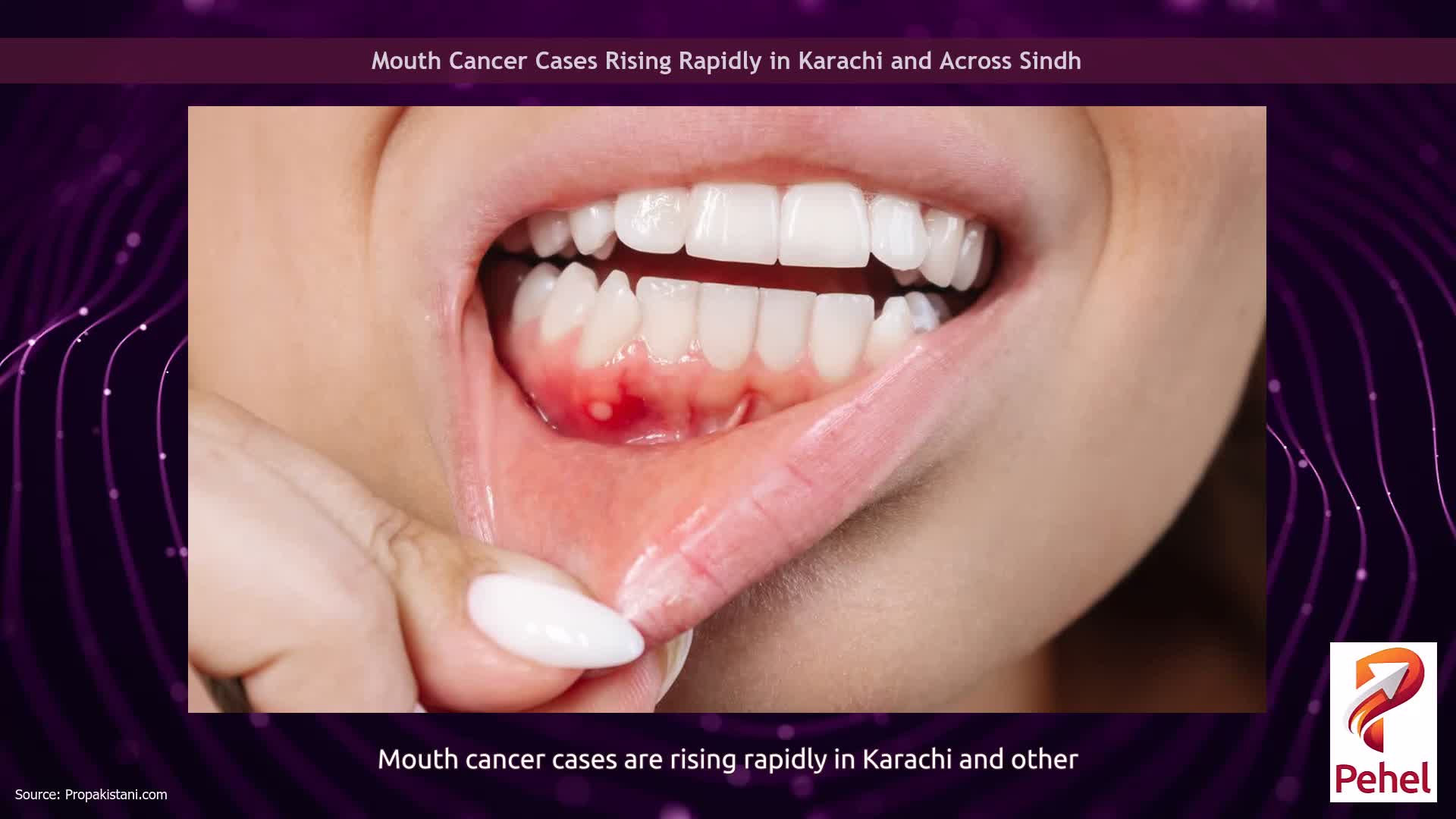 Mouth Cancer Cases Rising Rapidly in Karachi and Across Sindh