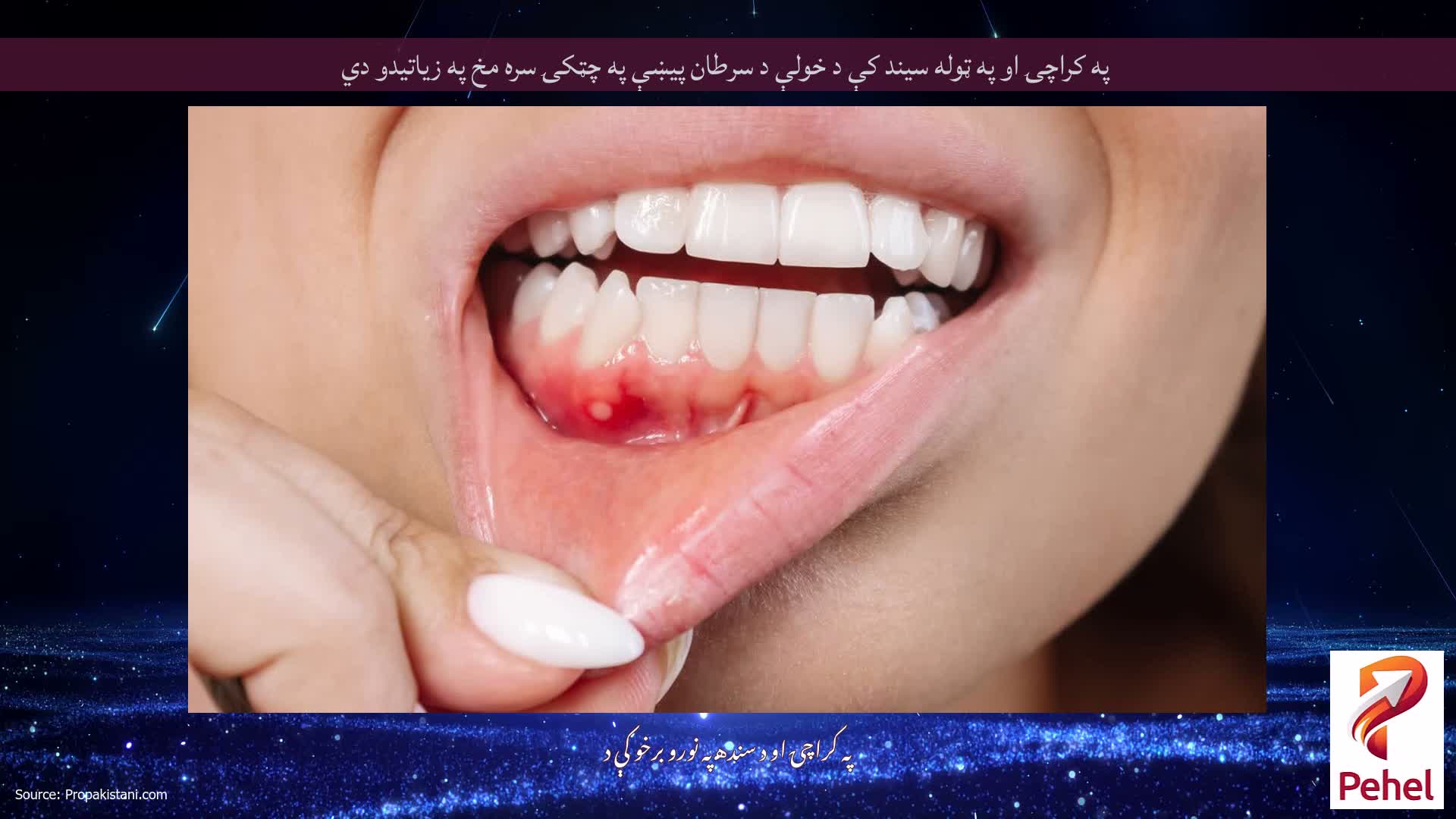 په کراچۍ او په ټوله سیند کې د خولې د سرطان پیښې په چټکۍ سره مخ په زیاتیدو دي