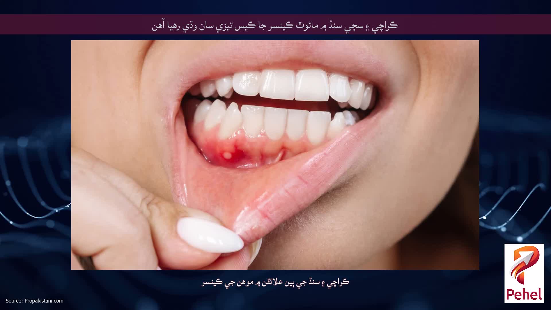 ڪراچي ۽ سڄي سنڌ ۾ مائوٿ ڪينسر جا ڪيس تيزي سان وڌي رهيا آهن