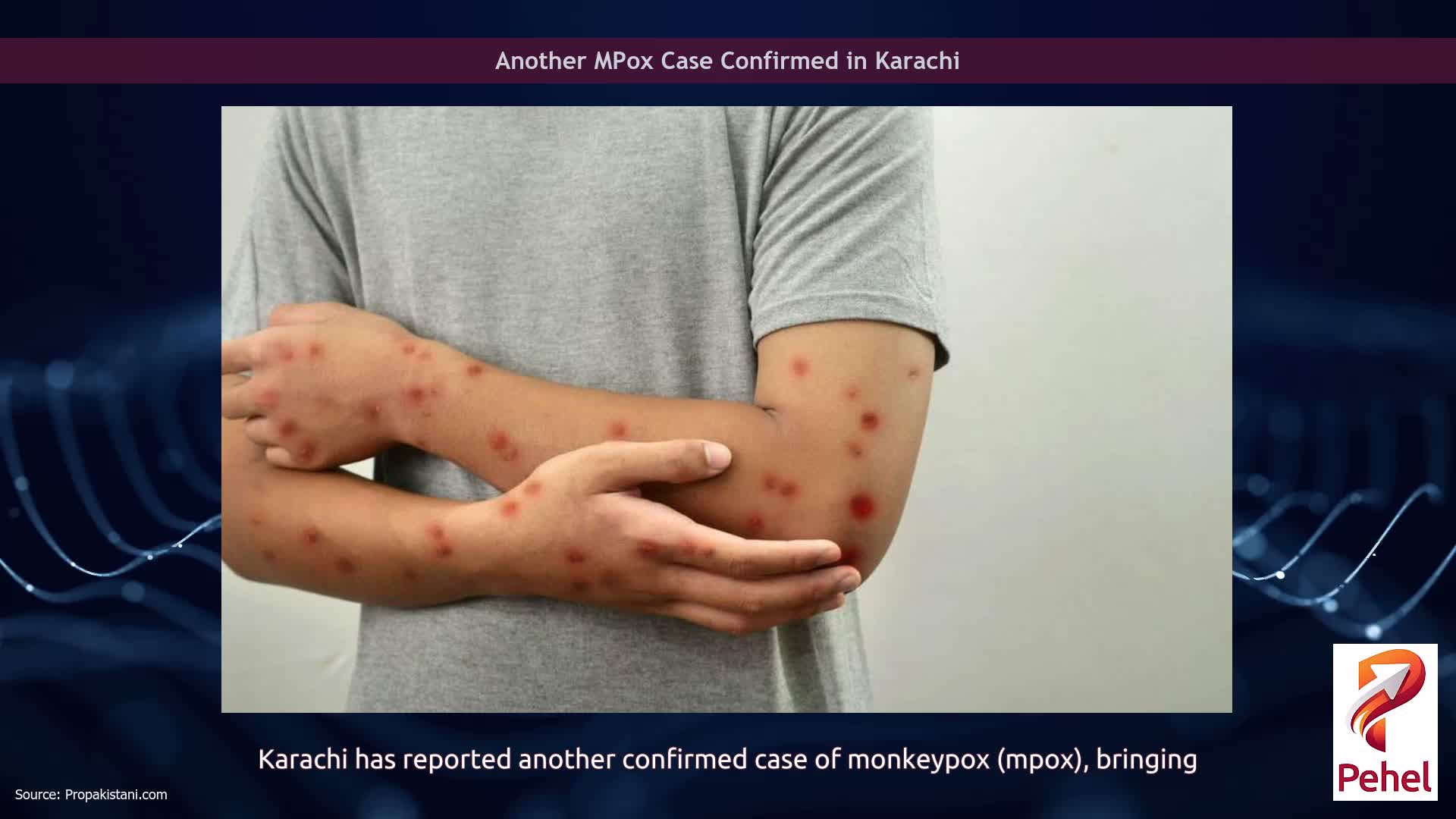 Another MPox Case Confirmed in Karachi
