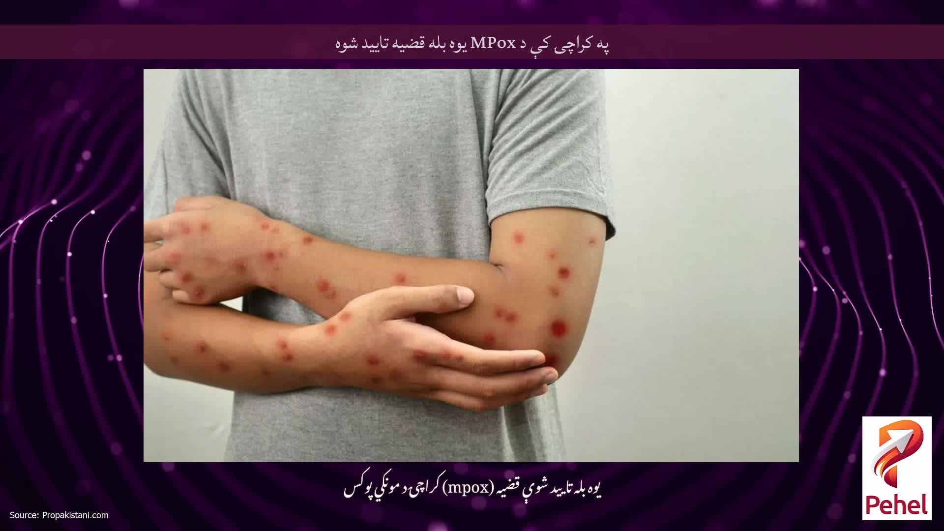 په کراچۍ کې د MPox یوه بله قضیه تایید شوه