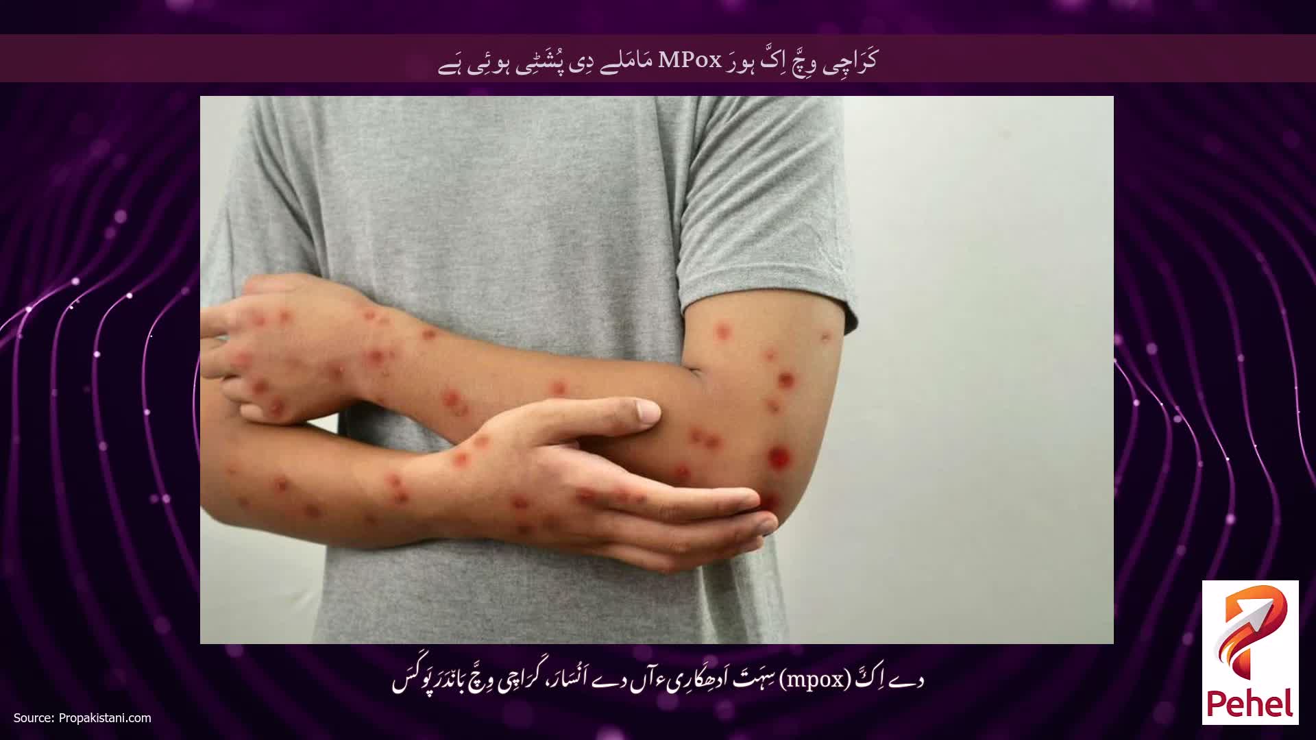 کَرَاچِی وِچَّ اِکَّ ہورَ MPox مَامَلے دِی پُشَٹِی ہوئِی ہَے