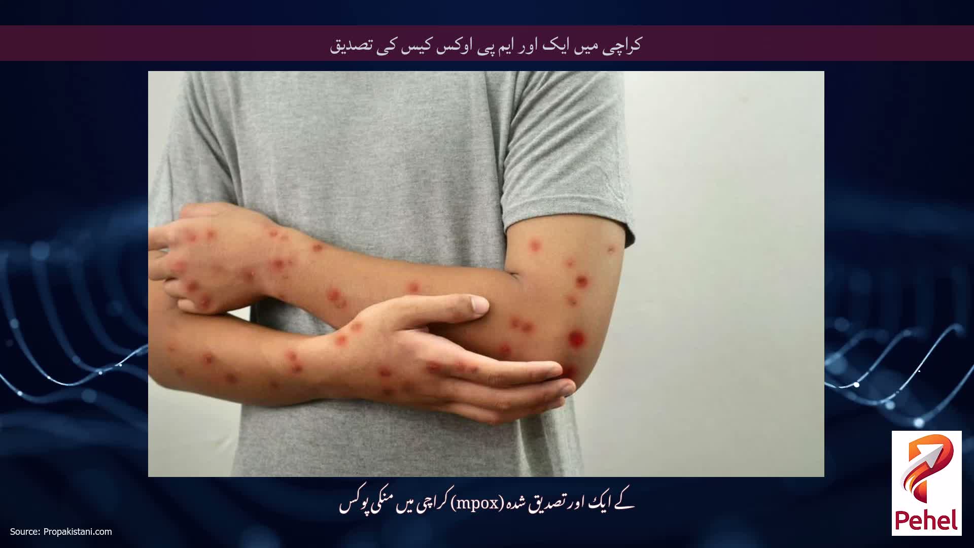 کراچی میں ایک اور ایم پی اوکس کیس کی تصدیق